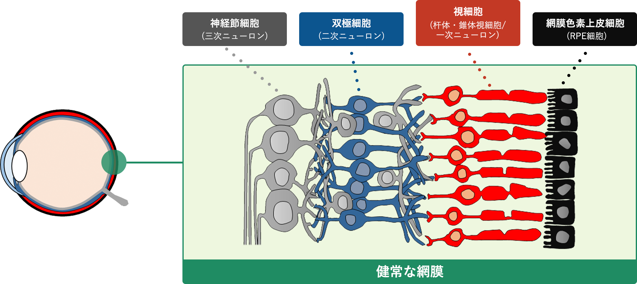網膜色素変性への網膜シート(DSP-3077)移植